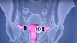 600 muertes por cáncer de cuello uterino en el país