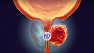 Médicos de AL experimentan con biomarcadores para atender cáncer de próstata