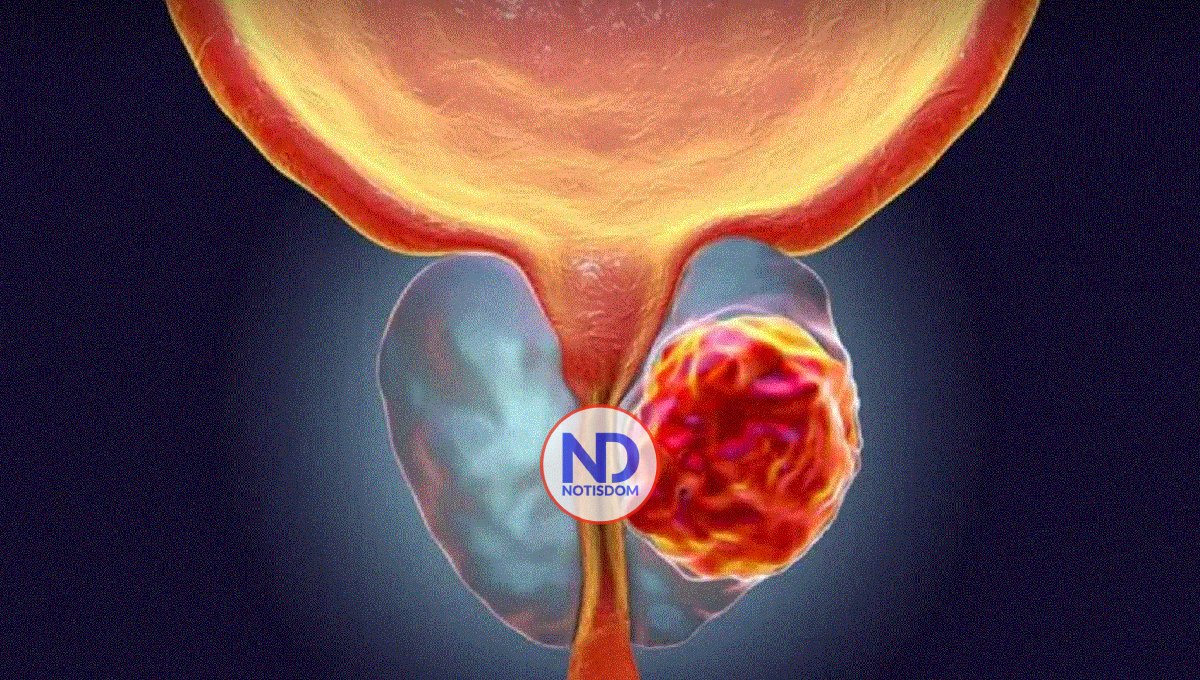 Médicos de AL experimentan con biomarcadores para atender cáncer de próstata