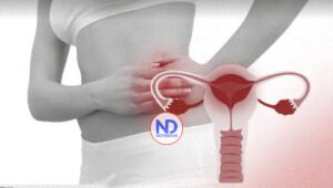 Enfermedad inflamatoria pélvica