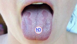 El color de la lengua puede ser determinante para su salud