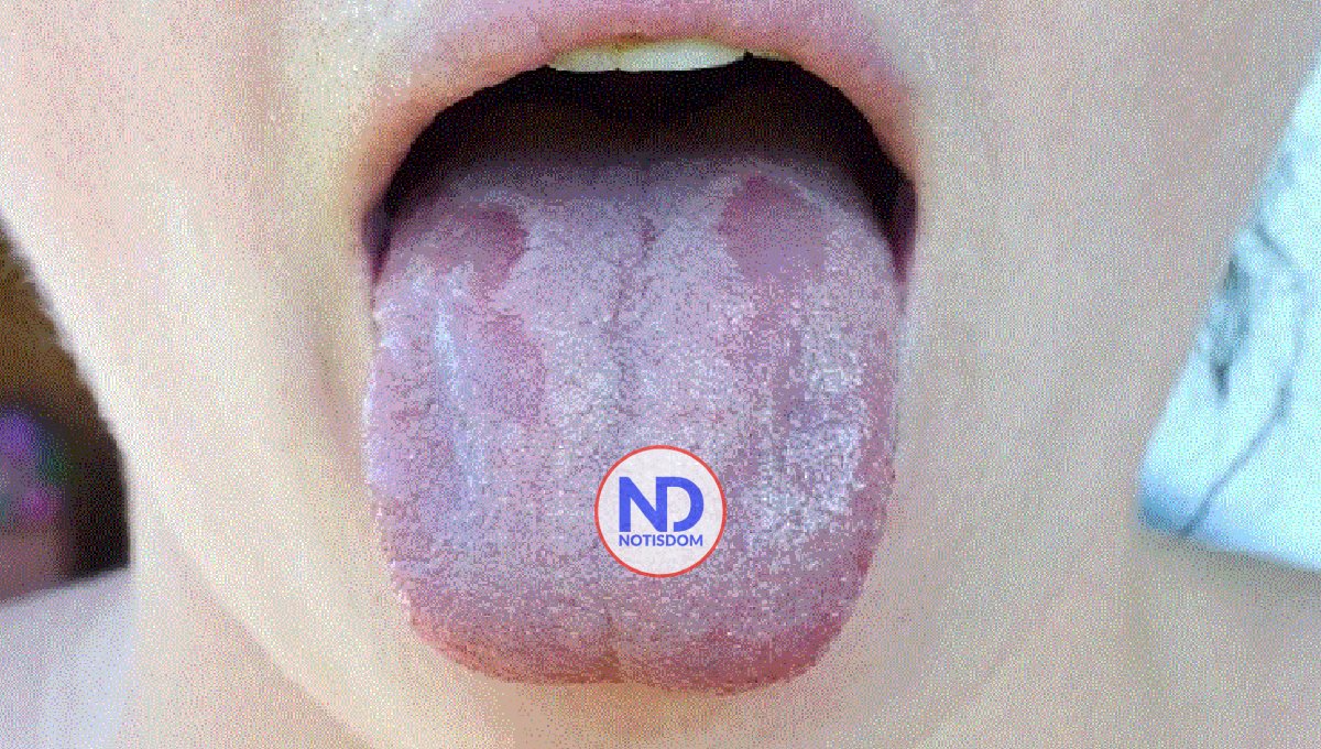 El color de la lengua puede ser determinante para su salud