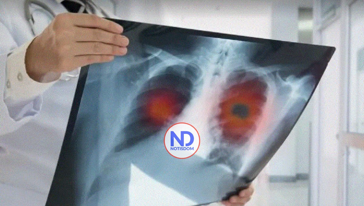 Establecen cómo la contaminación atmosférica puede provocar cáncer de pulmón 2 Establecen cómo la contaminación atmosférica puede provocar cáncer de pulmón