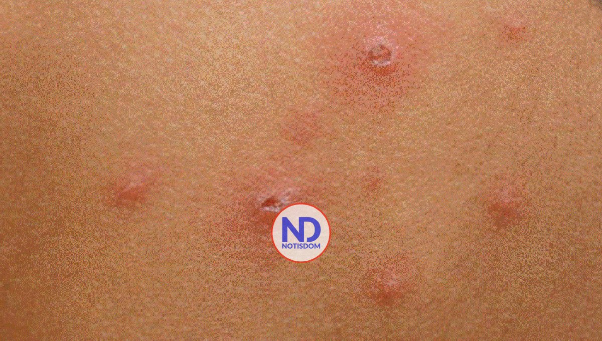 Instituto Dermatológico insta a no automedicarse para tratar la varicela