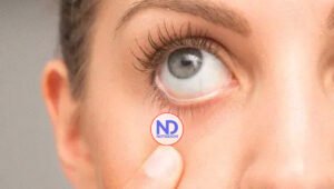 Cómo diferenciar la alergia ocular del ojo seco