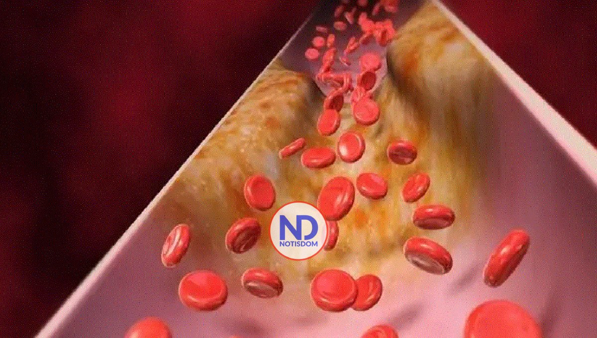 La acumulación de placas en las arterias hace que envejezcamos más rápido