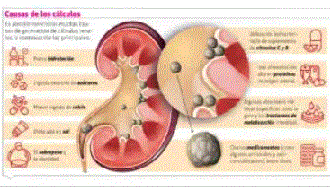 CALCULO RENALES Cálculos renales, ¿por qué aparecen y cómo evitarlos?