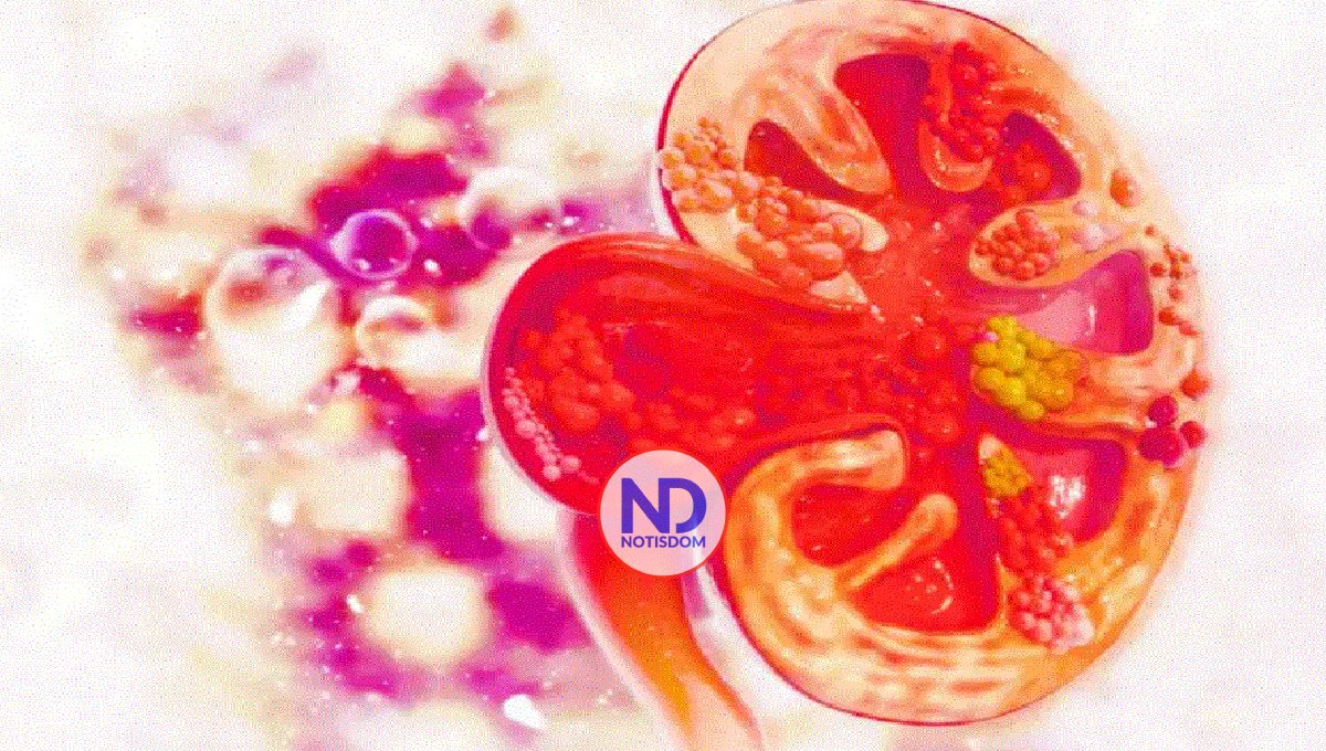 Cálculos renales, ¿por qué aparecen y cómo evitarlos?