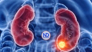 Tres mil muertes al año por causa del cáncer renal en Centroamérica