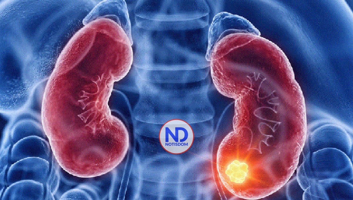 Tres mil muertes al año por causa del cáncer renal en Centroamérica