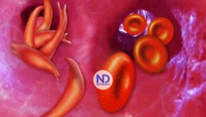 Principales síntomas de la anemia falciforme