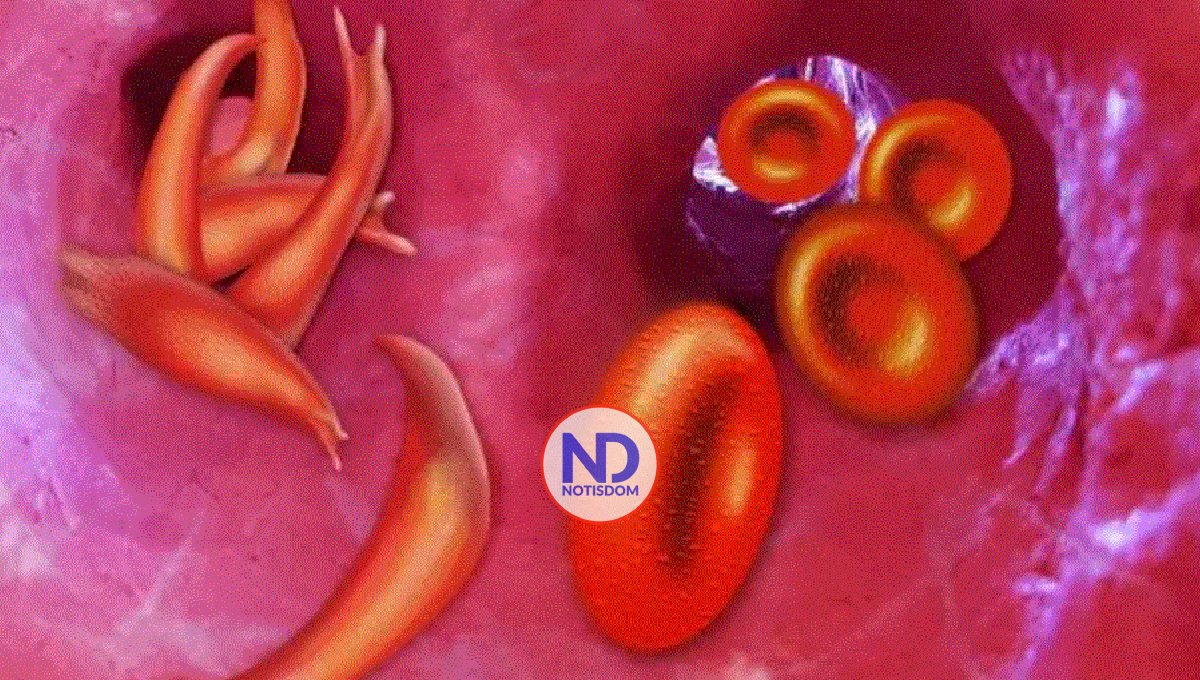 Principales síntomas de la anemia falciforme