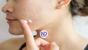 La aparición de acné e irritación en verano