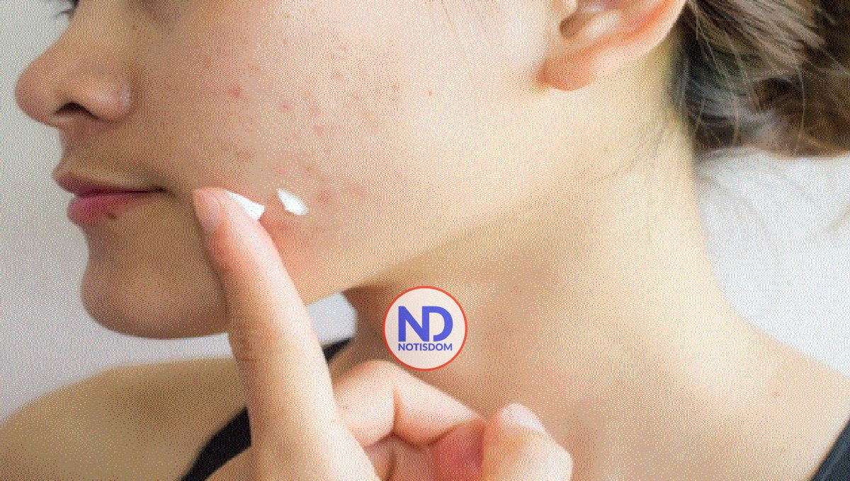 La aparición de acné e irritación en verano