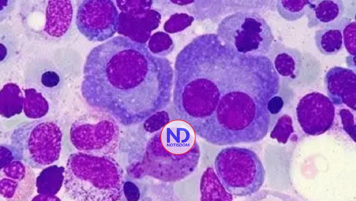 Desarrollan una nueva inmunoterapia para pacientes con mieloma múltiple resistente