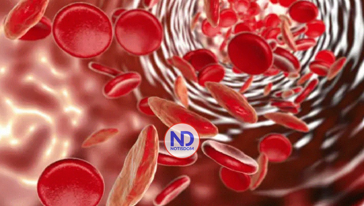 Una cuarta parte de la población sufre anemia, sobre todo mujeres y niños