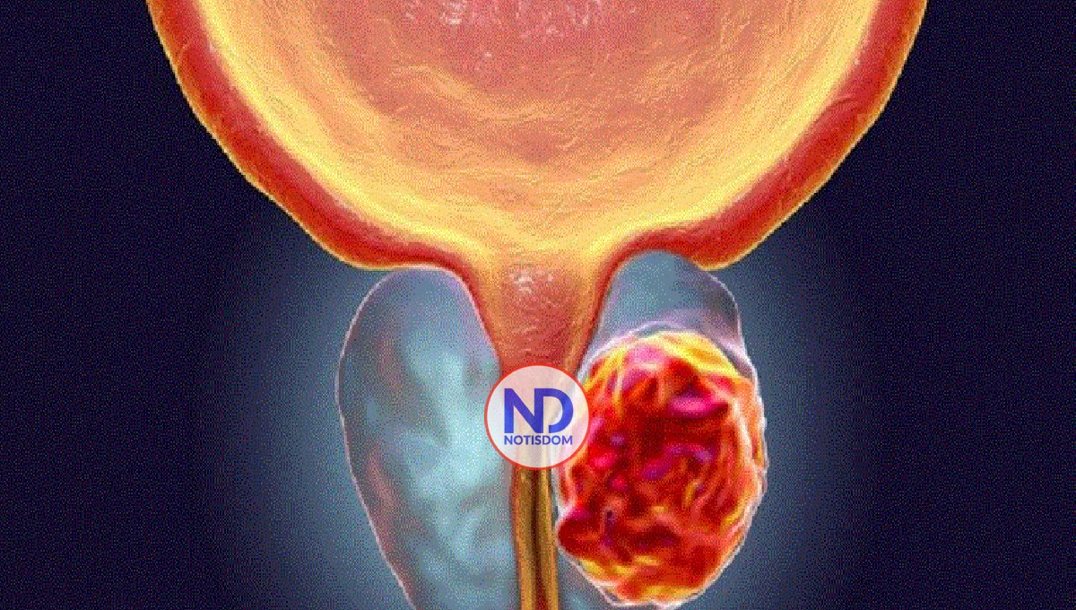 Contaminación del aire puede aumentar riesgo cáncer de próstata