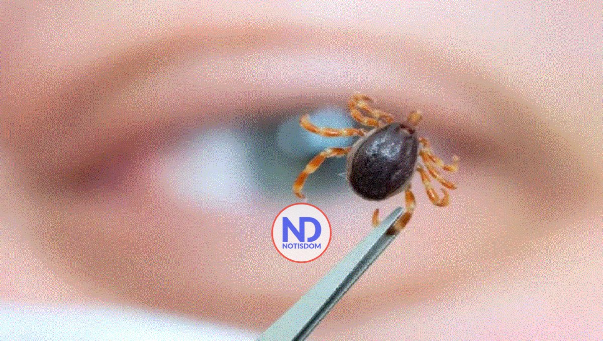 Alergia a la carne asociada a las garrapatas