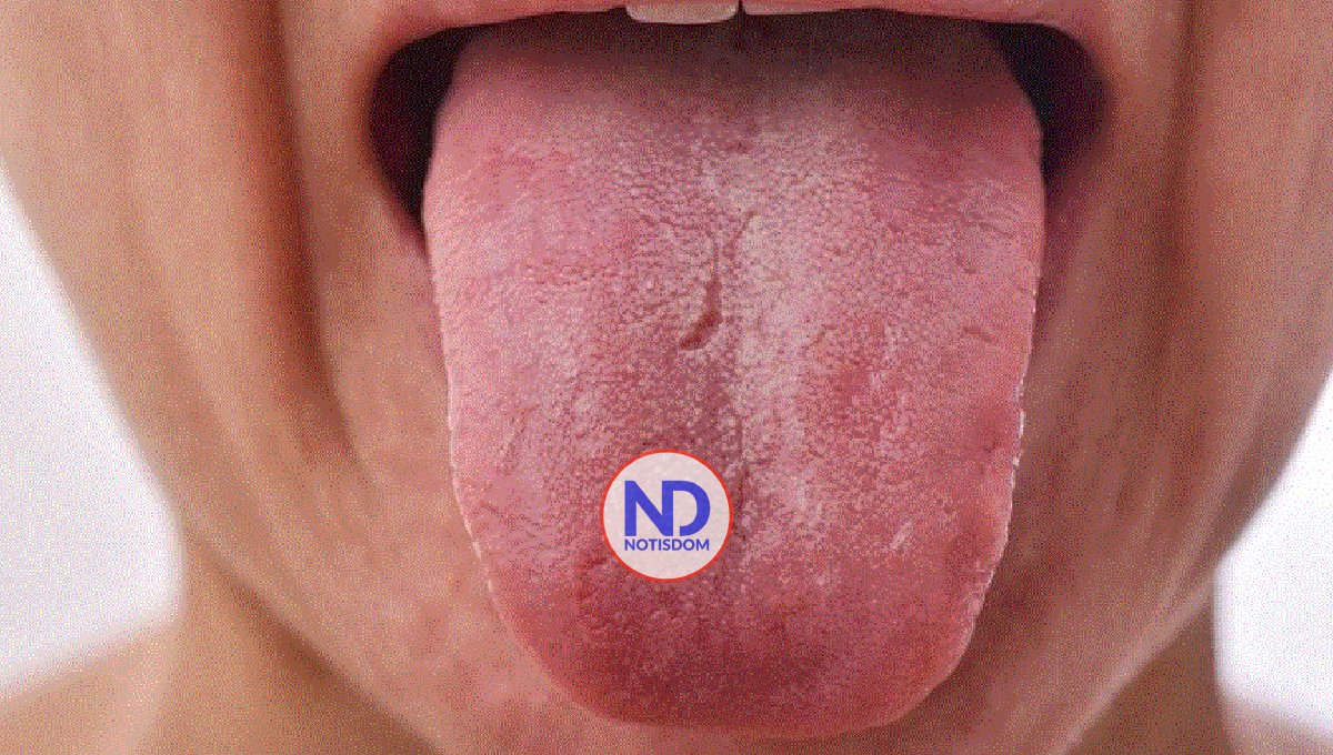 Advierten estado de la lengua puede reflejar enfermedades