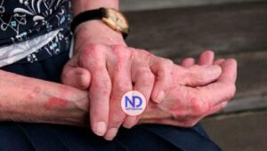 Investigación halla evidencias de que la lepra se ha vuelto endémica en el sureste de EE.UU.