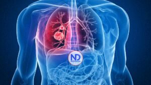 El diagnóstico temprano y avances en tratamiento podrían reducir tasa de mortalidad de cáncer de pulmón