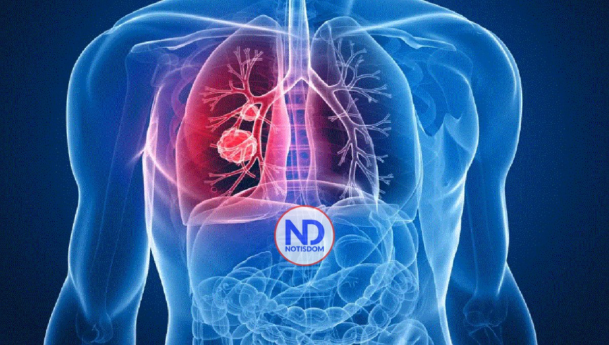 El diagnóstico temprano y avances en tratamiento podrían reducir tasa de mortalidad de cáncer de pulmón