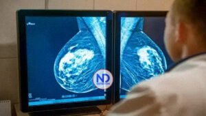 Innovación mejora expectativa de vida en pacientes de cáncer de mama metastásico