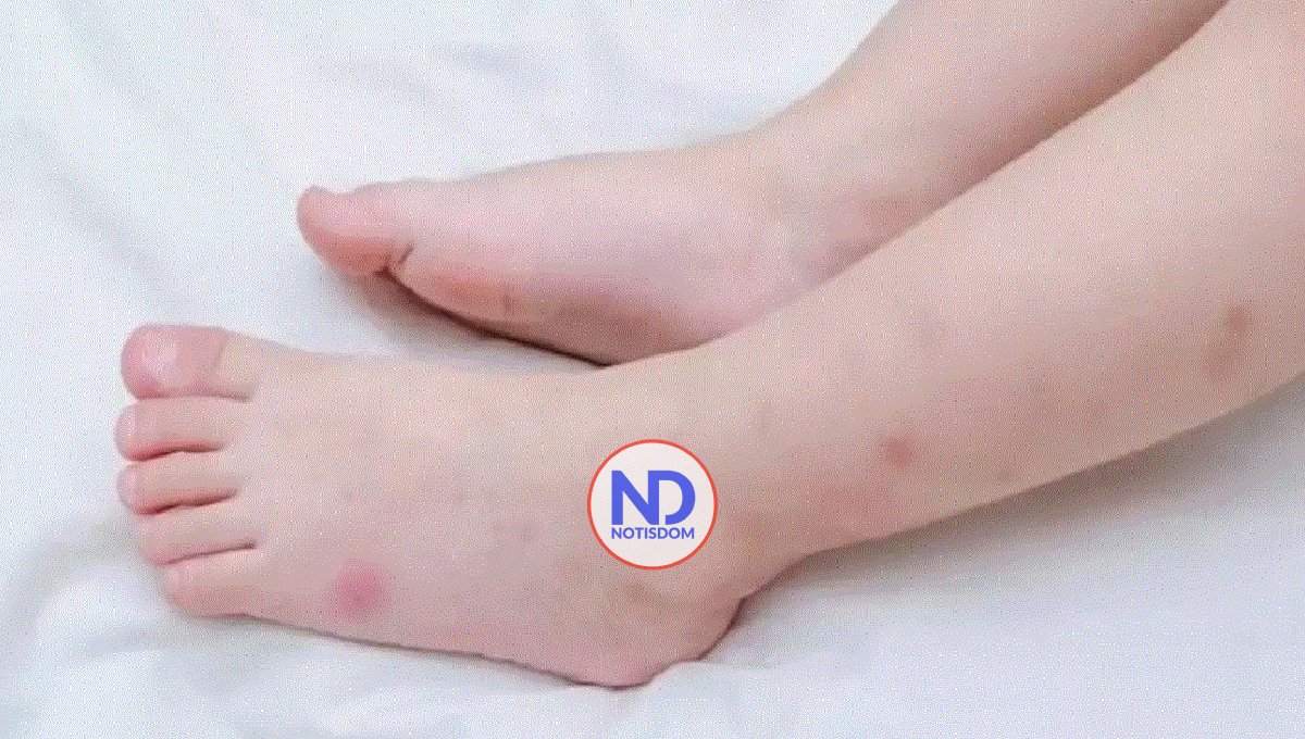 Tres niños en Cuidados Intensivos por dengue