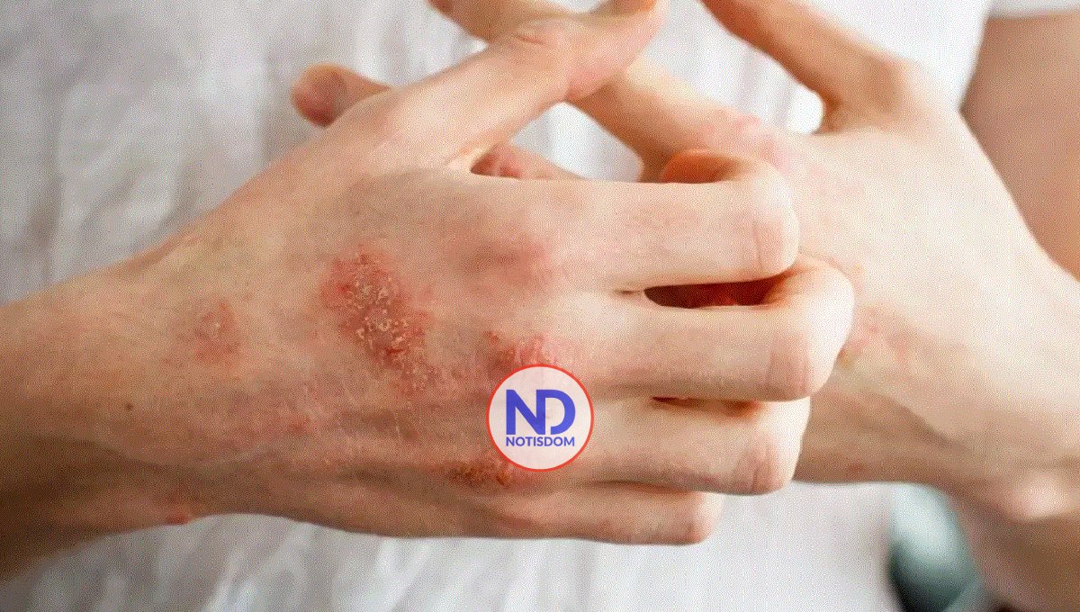 Hoy se celebra el Día Mundial de la Dermatitis Atópica