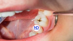 Desarrollan prueba casera puede advertir sobre riesgos de caries