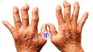 Entre el 1 y 2% de la población dominicana padece de artritis reumatoide