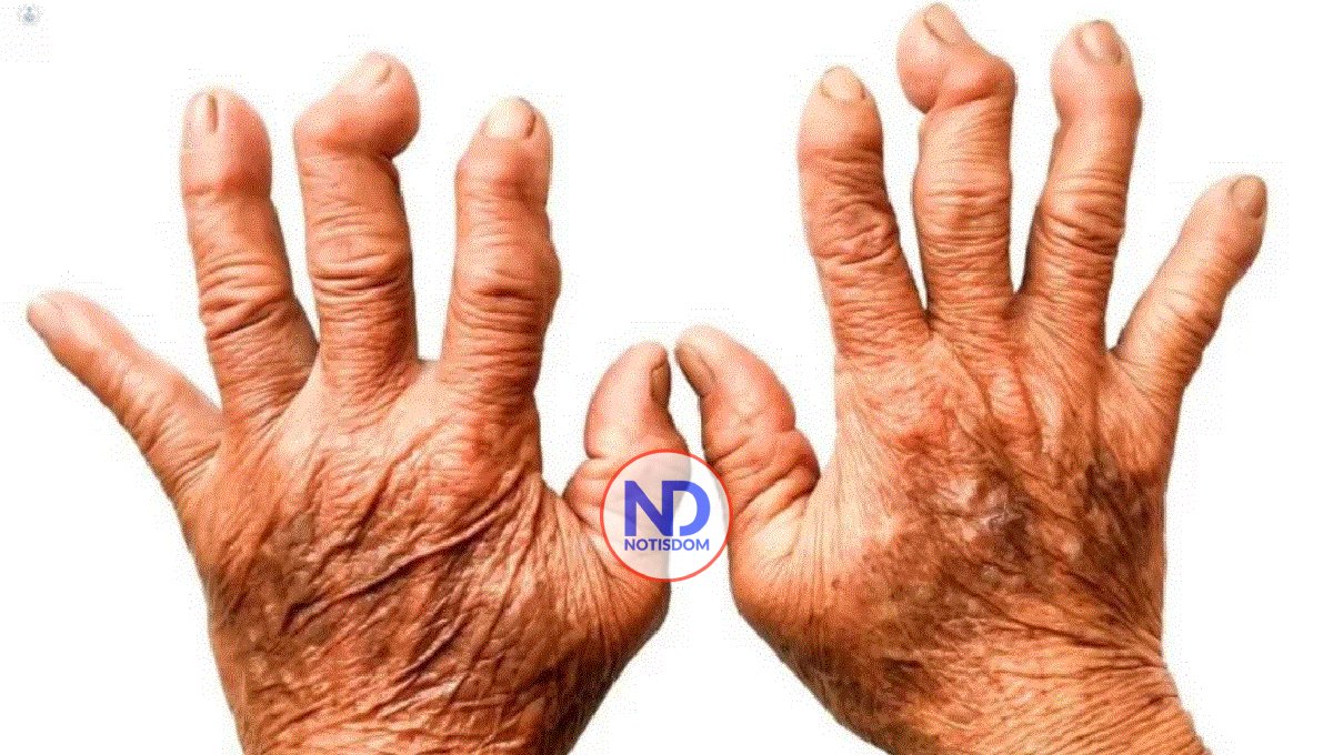 Entre el 1 y 2% de la población dominicana padece de artritis reumatoide