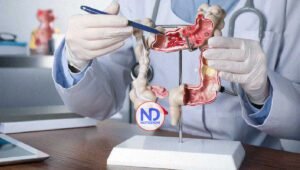 Mortalidad por cáncer de colon ha subido un 20,5 % en Latinoamérica en 30 años