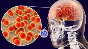 Meningitis apaga 290,000 vidas cada año alrededor del mundo
