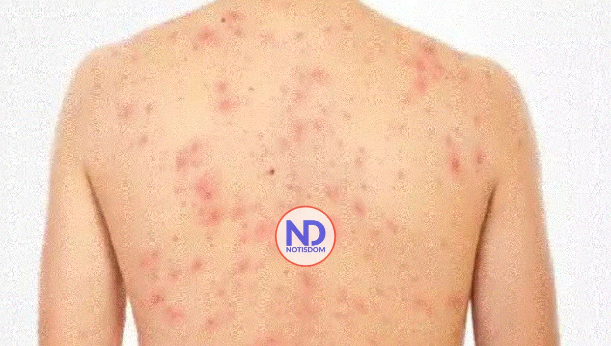 Salud Pública emite alerta epidemiológica por sarampión