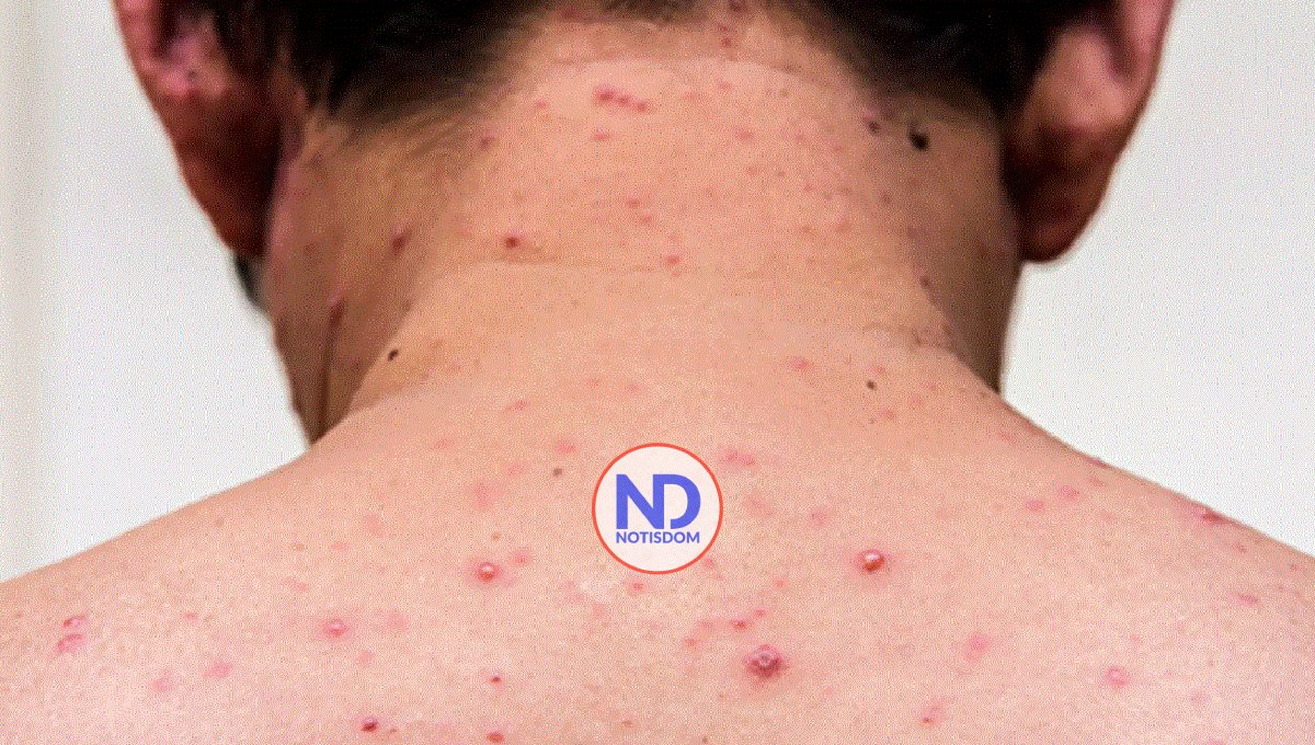 Sarampión: forma de contagio y métodos de prevención