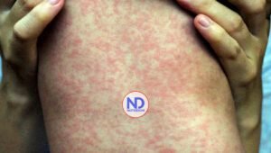 RD emite alerta epidemiológica por sarampión