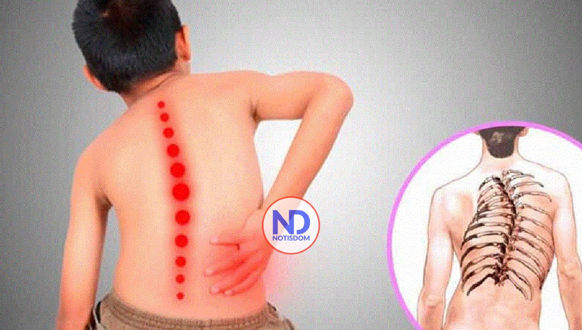 Atrofia Muscular Espinal: segunda causa genética mortalidad infantil