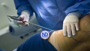 Especialista dice la liposucción tradicional está quedando obsoleta