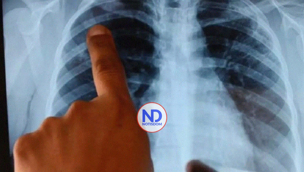 México registra más de 7,500 nuevos casos de cáncer de pulmón 2 México registra más de 7,500 nuevos casos de cáncer de pulmón