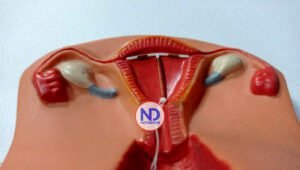 ¿Es cierto que hay durar 15 días sin tener relaciones íntimas luego de colocarse el DIU?