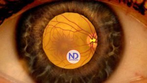 ¿Qué es el edema macular y quienes pueden padecerlo?