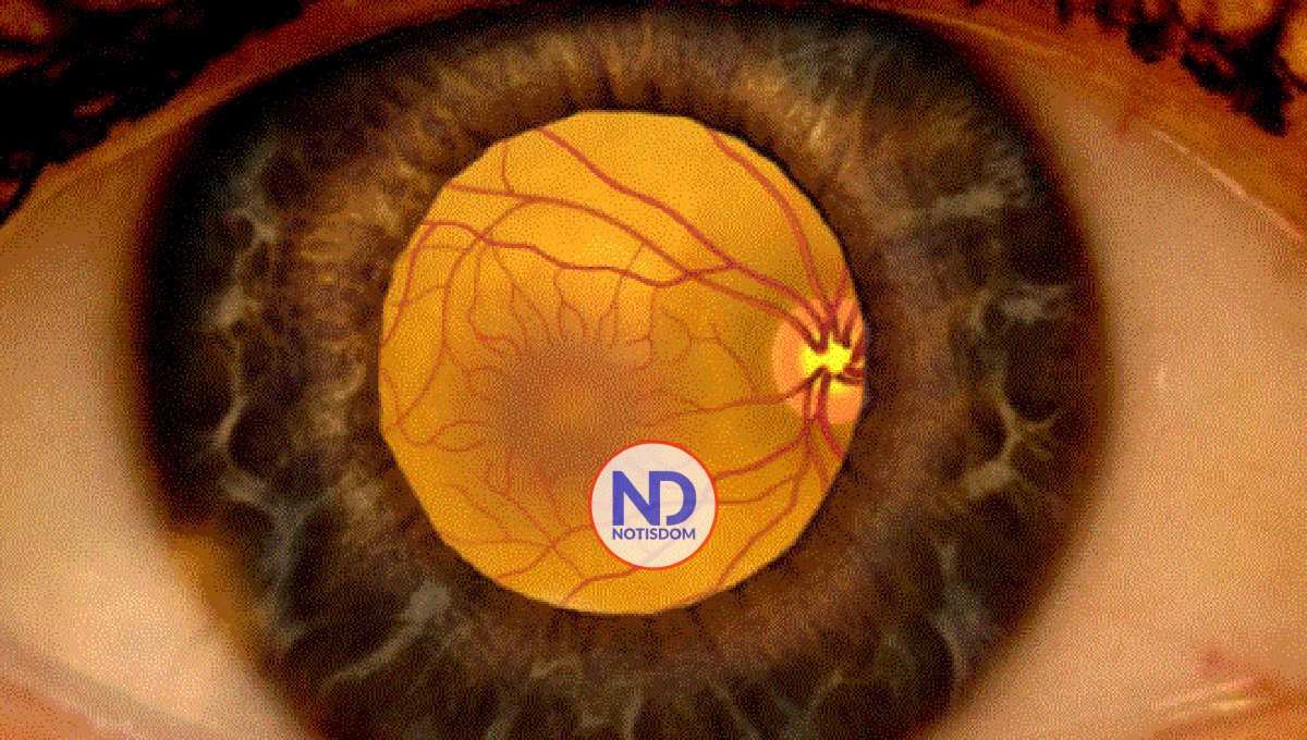 ¿Qué es el edema macular y quienes pueden padecerlo? 2 ¿Qué es el edema macular y quienes pueden padecerlo?