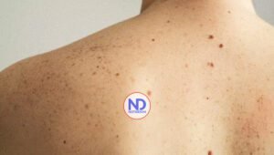 Desde el 2025 podría estar disponible vacuna contra cáncer de piel