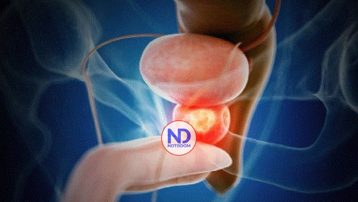 Importancia de la concientización y prevención cáncer de prostata