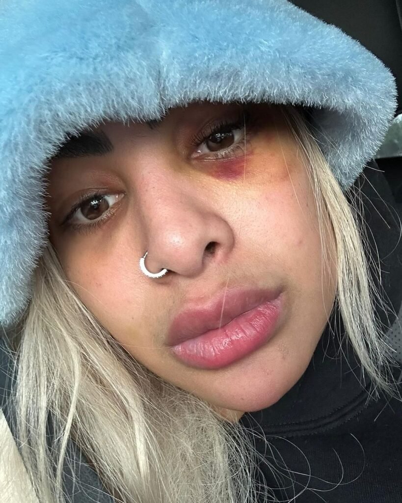 yailin 21 Salen a la luz nuevas fotos de Yailin La Más Viral golpeada