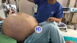Extirpan un tumor de más de 50 kilos del abdomen de una mujer en Italia