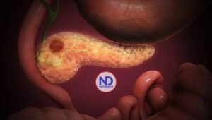 Ensayo clínico muestra eficacia en terapia contra un tipo de tumor de páncreas