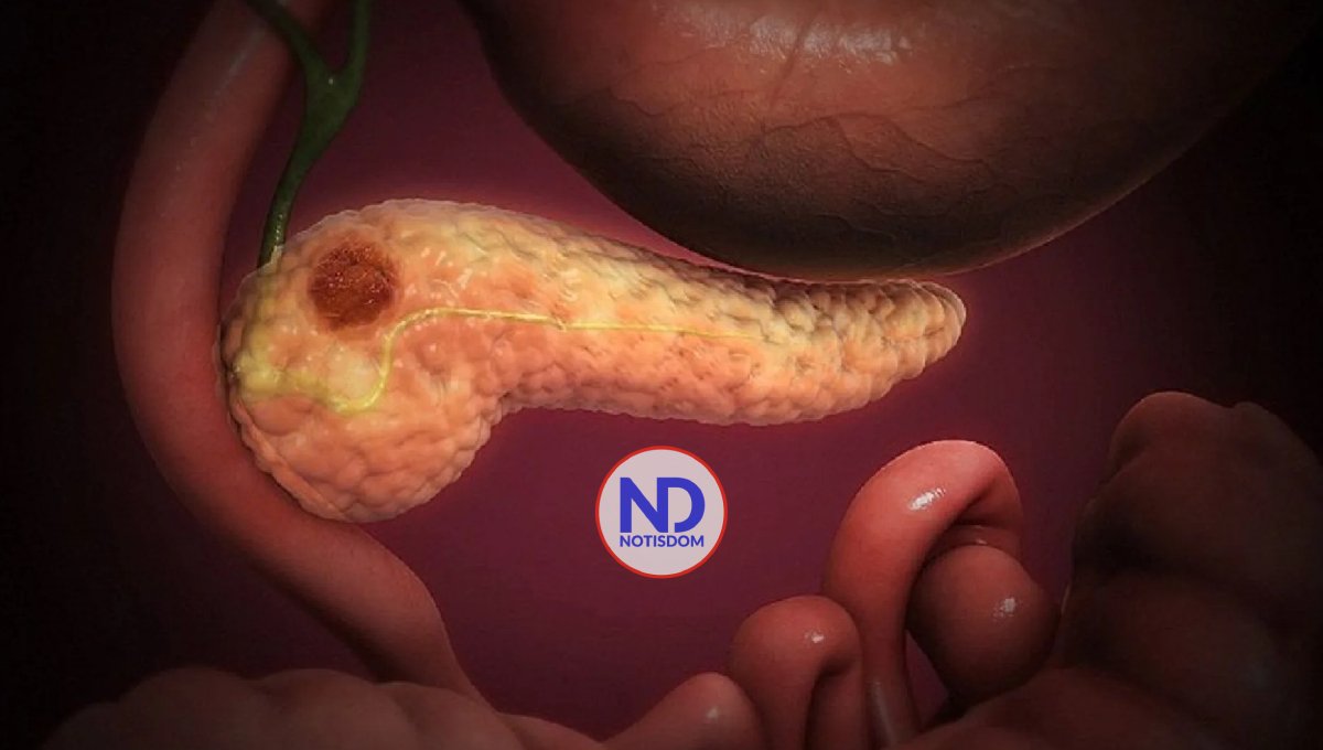 Ensayo clínico muestra eficacia en terapia contra un tipo de tumor de páncreas