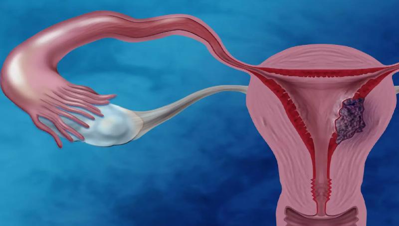 Estudio asocia contaminantes ambientales con mayor riesgo de cáncer de endometrio